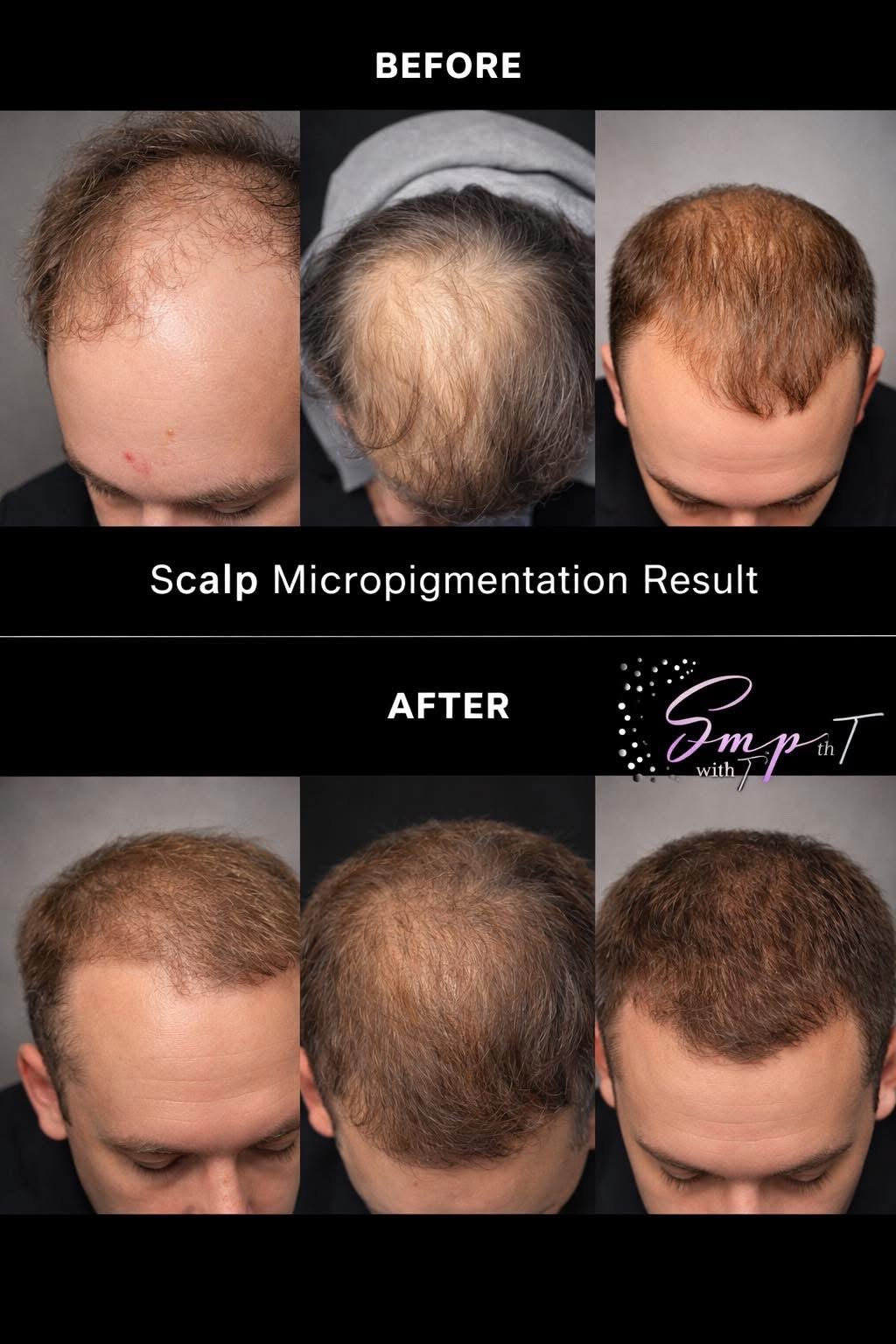 SMP Scalp Micropigmentation Before and After