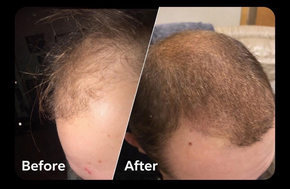 Crown and Top Hair Density Before and After